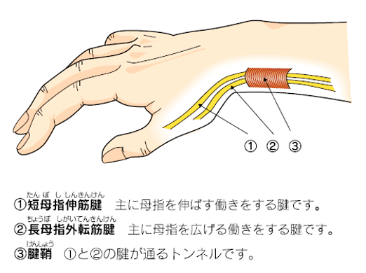ドゥ・ケルバン腱鞘炎01