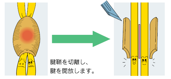 ドゥ・ケルバン腱鞘炎02