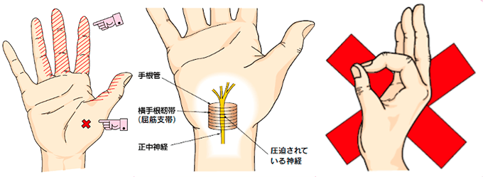 手根管症候群00