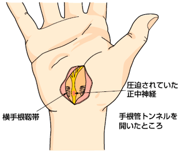 手根管症候群04