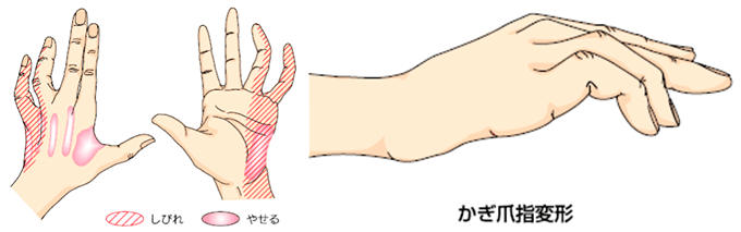肘部管症候群00